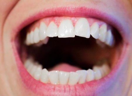 You are currently viewing Tooth decay and sore mouth