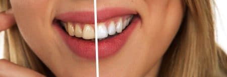 teeth yellow to white