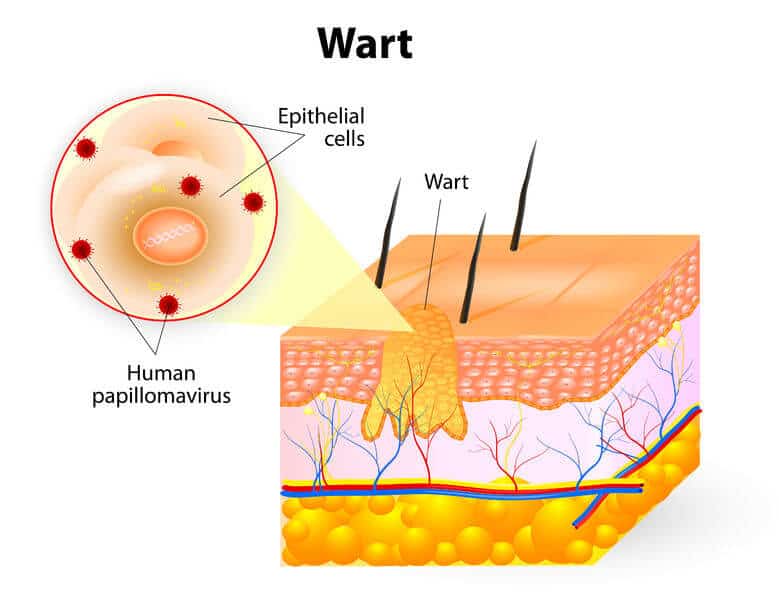 wart anatomy