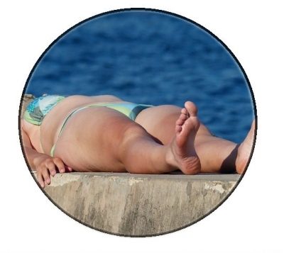 sunburn