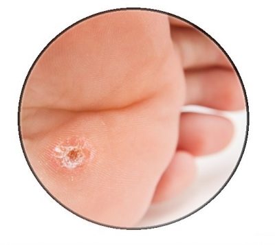 wart